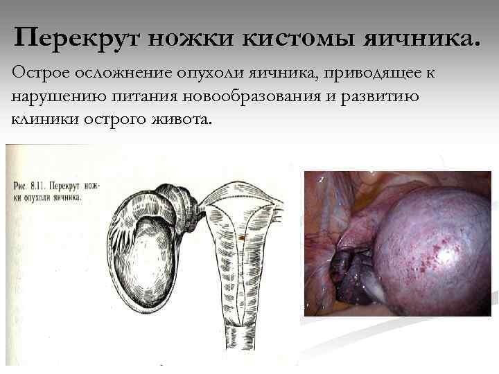 Перекрут ножки кистомы яичника. Острое осложнение опухоли яичника, приводящее к нарушению питания новообразования и