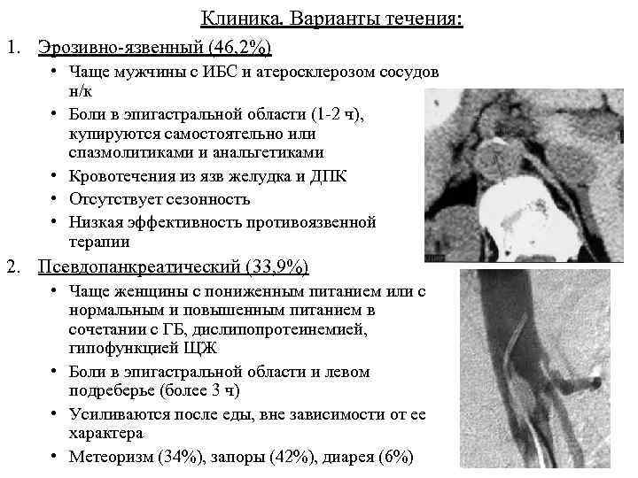 Клиника. Варианты течения: 1. Эрозивно-язвенный (46, 2%) • Чаще мужчины с ИБС и атеросклерозом