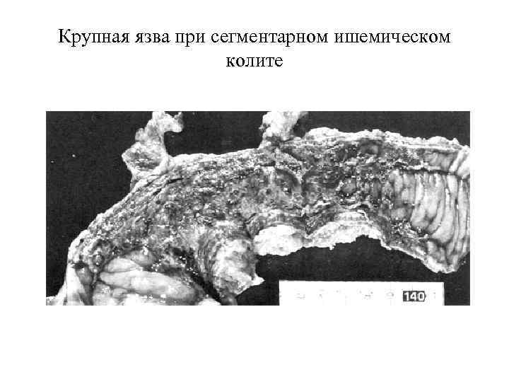Крупная язва при сегментарном ишемическом колите 