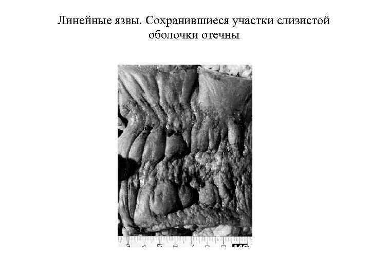 Линейные язвы. Сохранившиеся участки слизистой оболочки отечны 