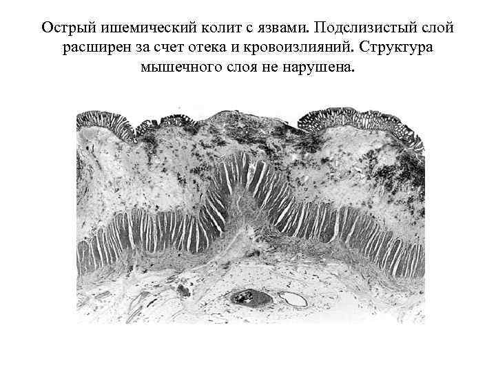 Острый ишемический колит с язвами. Подслизистый слой расширен за счет отека и кровоизлияний. Структура