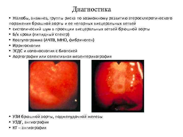 Диагностика • Жалобы, анамнез, группы риска по возможному развитию атеросклеротического поражения брюшной аорты и