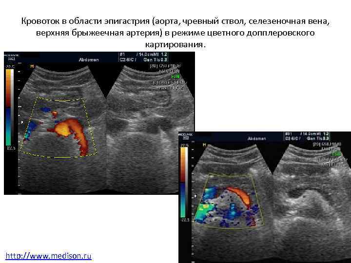 Кровоток в области эпигастрия (аорта, чревный ствол, селезеночная вена, верхняя брыжеечная артерия) в режиме