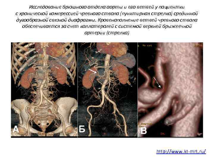 Исследование брюшного отдела аорты и его ветвей у пациентки с хронической компрессией чревного ствола