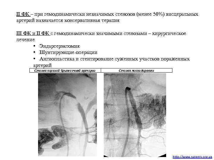 II ФК – при гемодинамически незначимых стенозов (менее 50%) висцеральных артерий назначается консервативная терапия