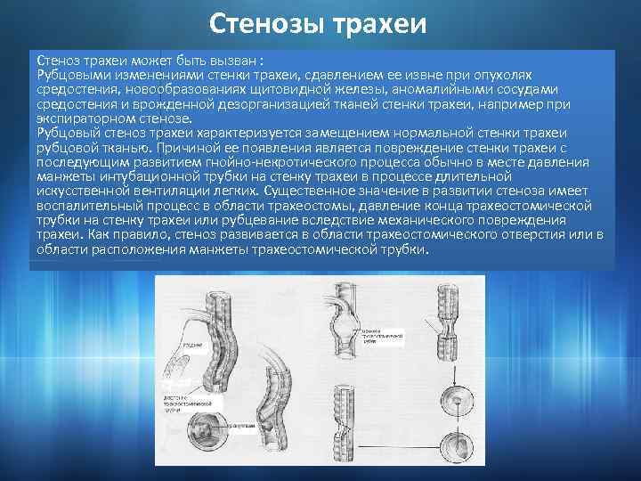 Стенозы трахеи Стеноз трахеи может быть вызван : Рубцовыми изменениями стенки трахеи, сдавлением ее