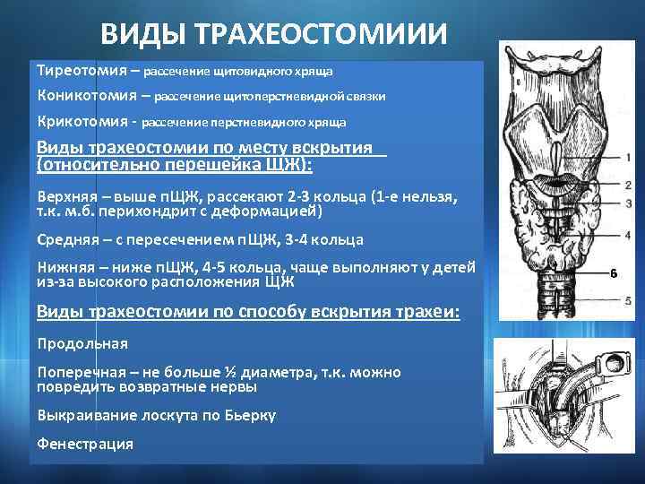 ВИДЫ ТРАХЕОСТОМИИИ Тиреотомия – рассечение щитовидного хряща Коникотомия – рассечение щитоперстневидной связки Крикотомия -