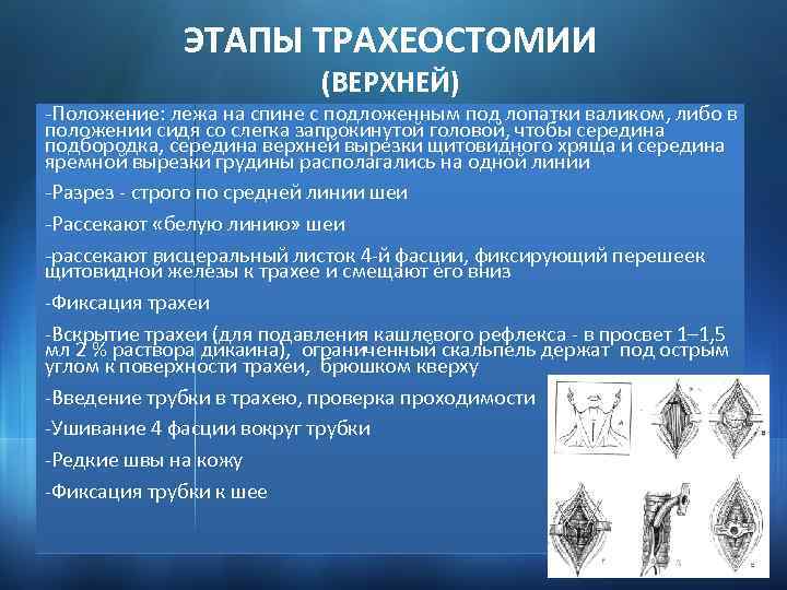 ЭТАПЫ ТРАХЕОСТОМИИ (ВЕРХНЕЙ) -Положение: лежа на спине с подложенным под лопатки валиком, либо в