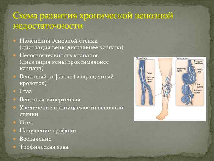 Схема развития хронической венозной недостаточности Изменения венозной стенки (дилатация вены дистальнее клапана) Несостоятельность клапанов