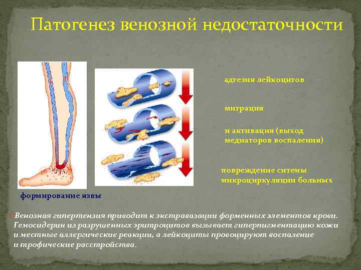 Патогенез венозной недостаточности адгезия лейкоцитов миграция и активация (выход медиаторов воспаления) повреждение ситемы микроциркуляции