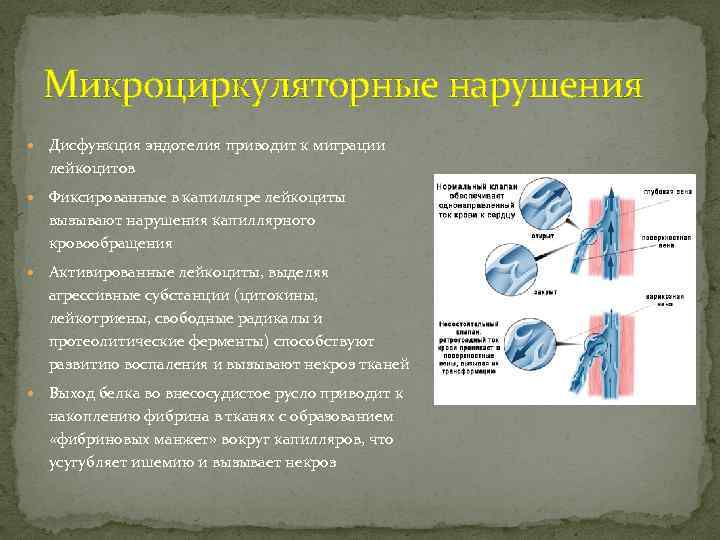 Микроциркуляторные нарушения Дисфункция эндотелия приводит к миграции лейкоцитов Фиксированные в капилляре лейкоциты вызывают нарушения