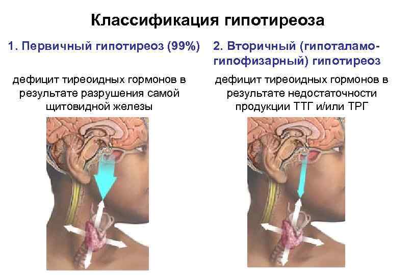 Классификация гипотиреоза 1. Первичный гипотиреоз (99%) дефицит тиреоидных гормонов в результате разрушения самой щитовидной