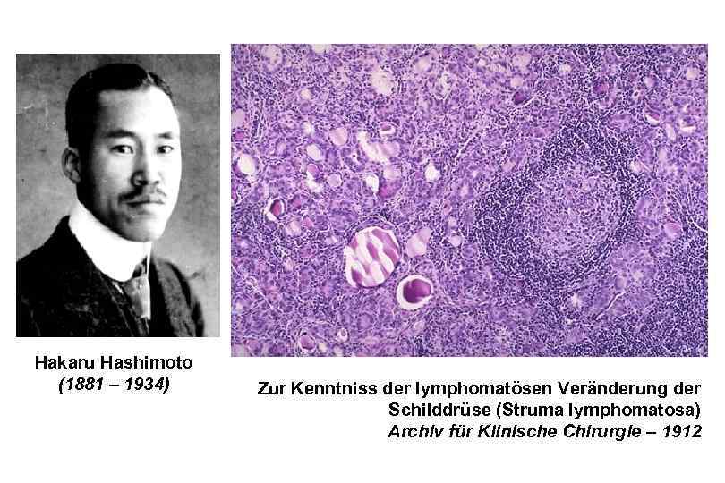 Hakaru Hashimoto (1881 – 1934) Zur Kenntniss der lymphomatösen Veränderung der Schilddrüse (Struma lymphomatosa)