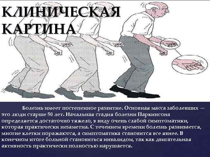 КЛИНИЧЕСКАЯ КАРТИНА Болезнь имеет постепенное развитие. Основная масса заболевших — это люди старше 50
