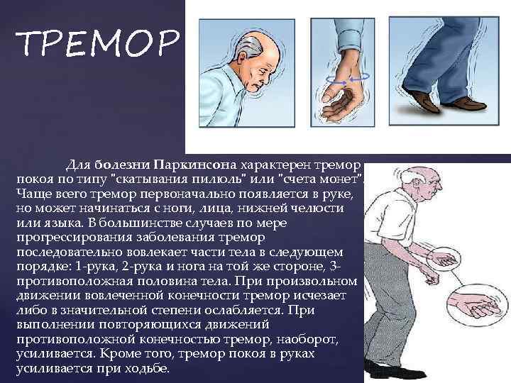 ТРЕМОР Для болезни Паркинсона характерен тремор покоя по типу 