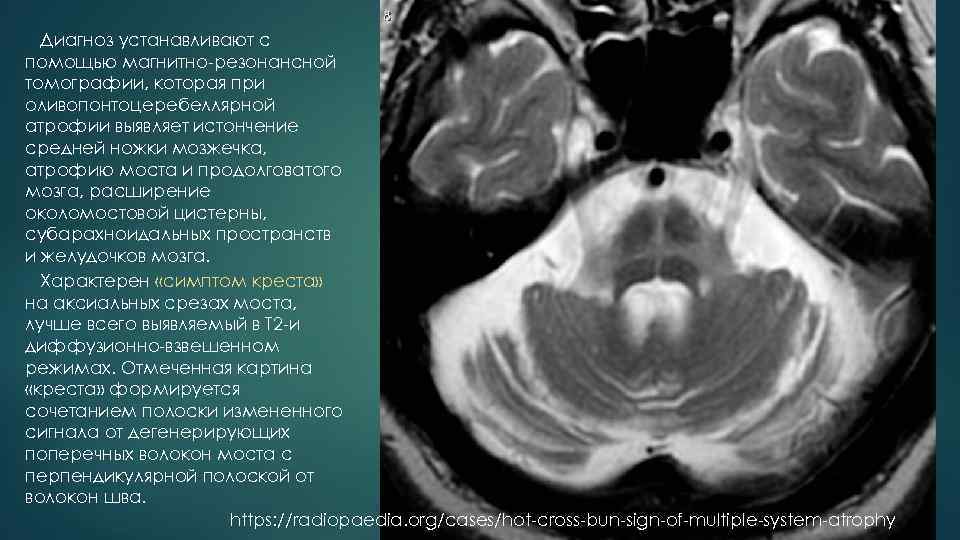 Диагноз устанавливают с помощью магнитно резонансной томографии, которая при оливопонтоцеребеллярной атрофии выявляет истончение средней