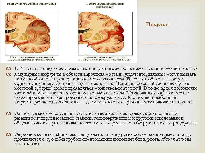 Инсульт 1. Инсульт, по видимому, самая частая причина острой атаксии в клинической практике. Лакунарные
