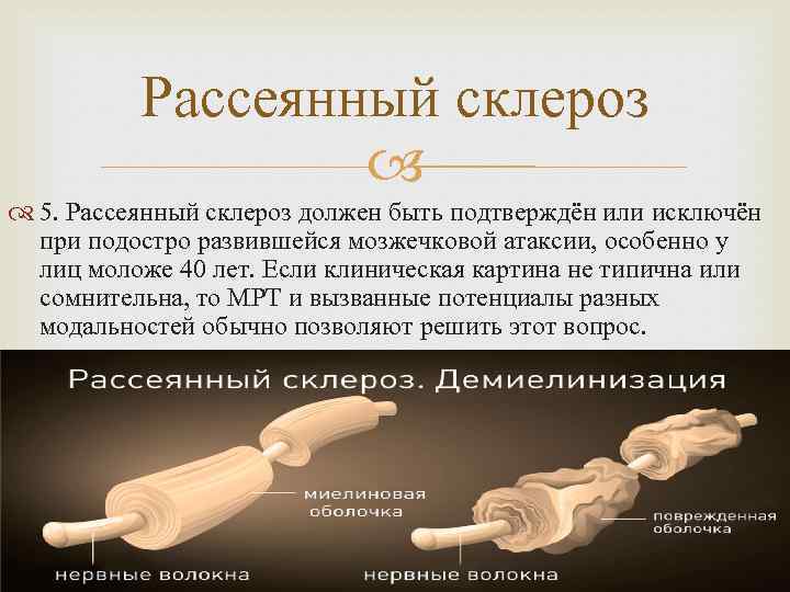 Рассеянный склероз 5. Рассеянный склероз должен быть подтверждён или исключён при подостро развившейся мозжечковой