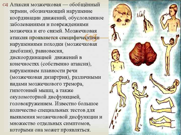  Атаксия мозжечковая — обобщённый термин, обозначающий нарушение координации движений, обусловленное заболеваниями и повреждениями