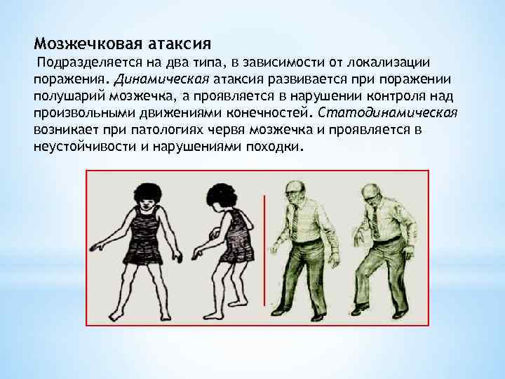 Мозжечковая атаксия Подразделяется на два типа, в зависимости от локализации поражения. Динамическая атаксия развивается