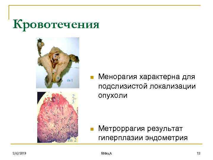 Кровотечения n n 2/6/2018 Менорагия характерна для подслизистой локализации опухоли Метроррагия результат гиперплазии эндометрия
