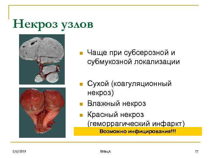 Некроз узлов n Чаще при субсерозной и субмукозной локализации n Сухой (коагуляционный некроз) Влажный