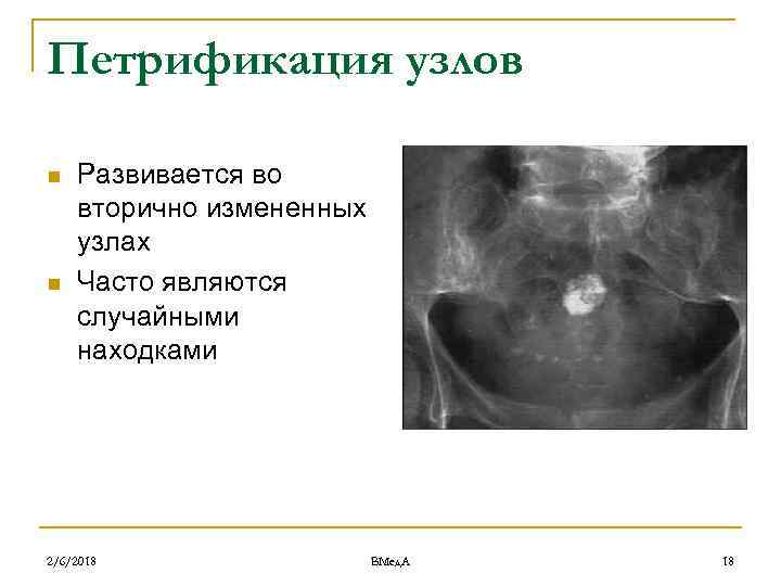 Петрификация узлов n n Развивается во вторично измененных узлах Часто являются случайными находками 2/6/2018