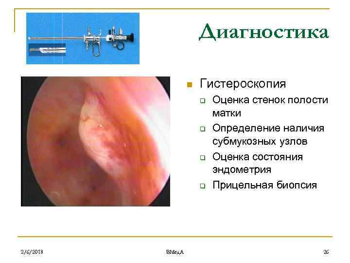 Диагностика n Гистероскопия q q 2/6/2018 ВМед. А Оценка стенок полости матки Определение наличия