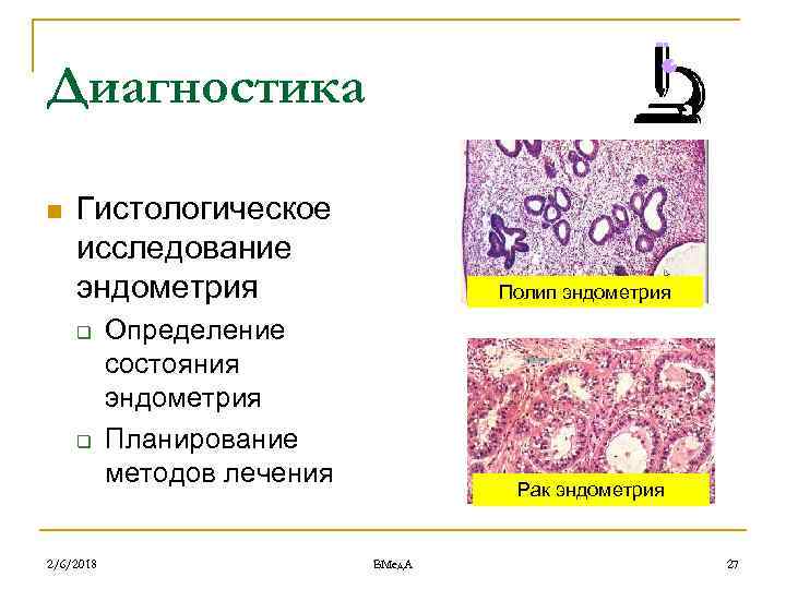 Диагностика n Гистологическое исследование эндометрия q q 2/6/2018 Полип эндометрия Определение состояния эндометрия Планирование