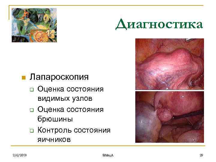 Диагностика n Лапароскопия q q q 2/6/2018 Оценка состояния видимых узлов Оценка состояния брюшины