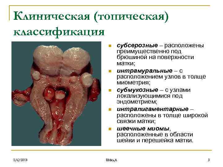 Клиническая (топическая) классификация n n n 2/6/2018 субсерозные – расположены преимущественно под брюшиной на