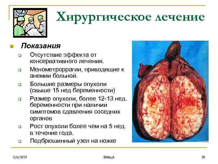 Хирургическое лечение n Показания q q q 2/6/2018 Отсутствие эффекта от консервативного лечения. Менометроррагии,