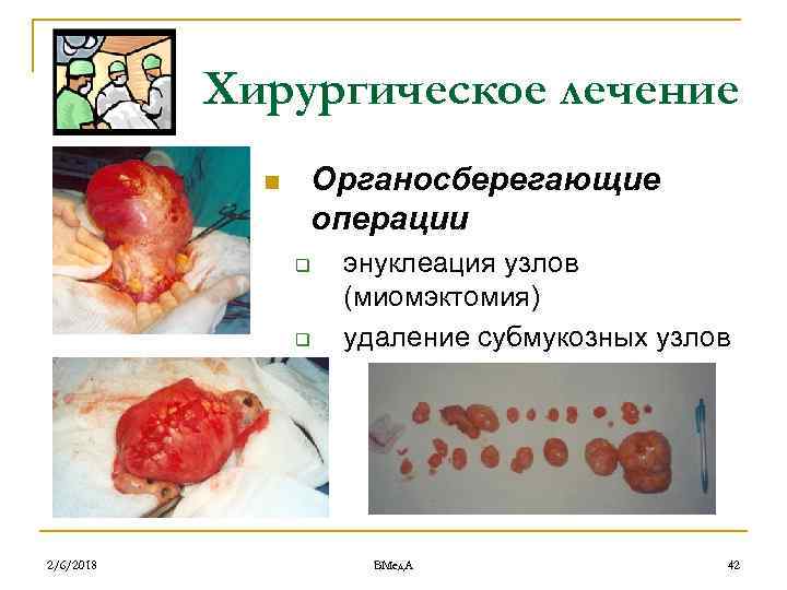 Хирургическое лечение Органосберегающие операции n q q 2/6/2018 энуклеация узлов (миомэктомия) удаление субмукозных узлов
