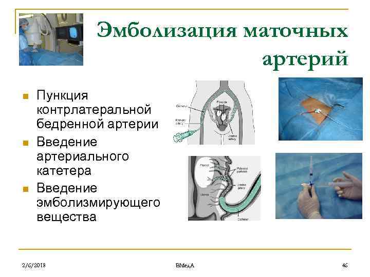 Эмболизация маточных артерий n n n Пункция контрлатеральной бедренной артерии Введение артериального катетера Введение