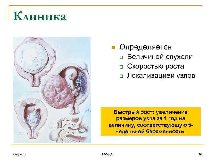 Клиника n Определяется q q q Величиной опухоли Скоростью роста Локализацией узлов Быстрый рост: