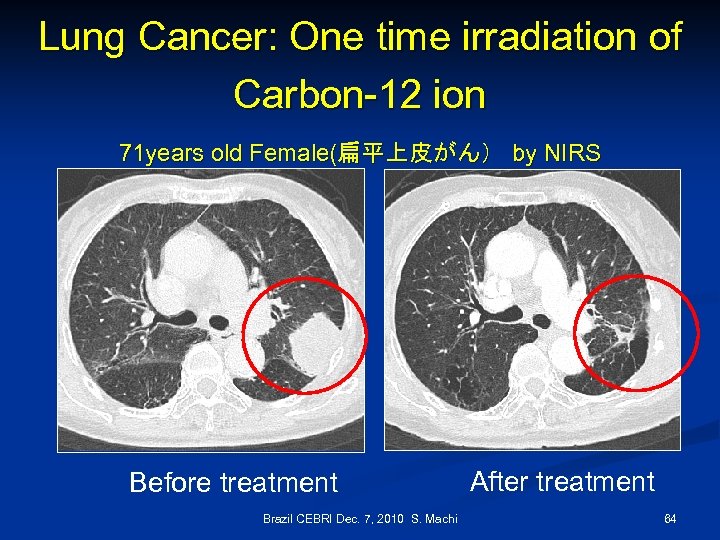 Lung Cancer: One time irradiation of Carbon-12 ion 71 years old Female(扁平上皮がん） by NIRS