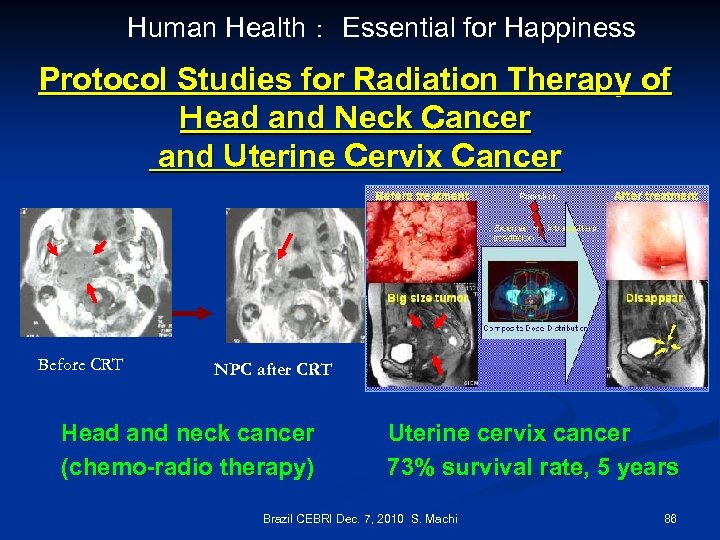 Human Health： Essential for Happiness Protocol Studies for Radiation Therapy of Ｈead and Ｎeck