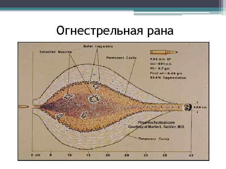 Огнестрельная рана 