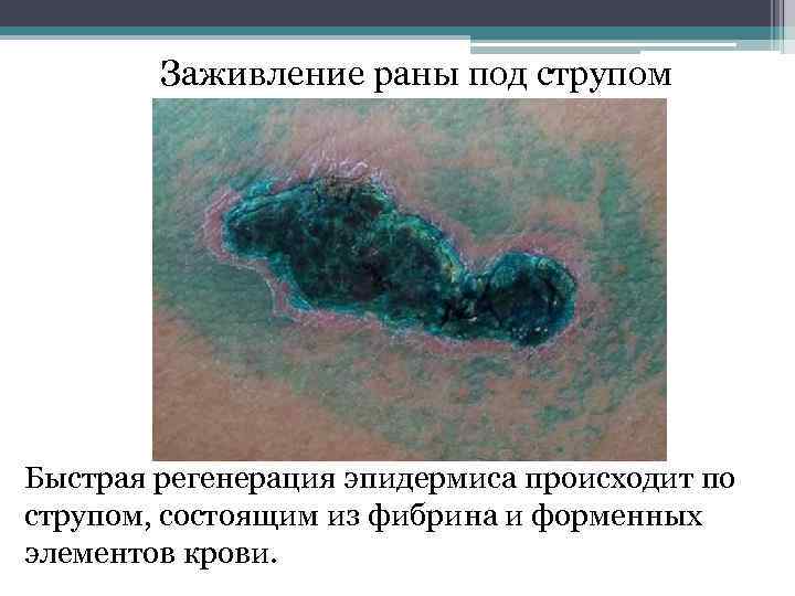 Заживление раны под струпом Быстрая регенерация эпидермиса происходит по струпом, состоящим из фибрина и