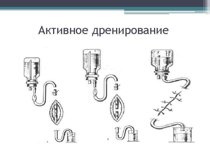 Картинки дренирование раны