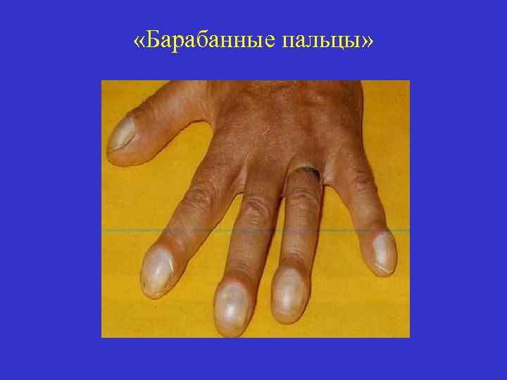  «Барабанные пальцы» 