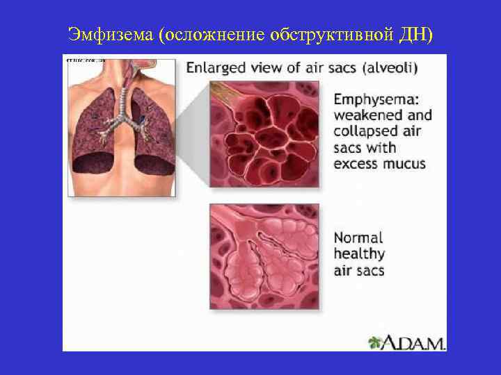 Эмфизема (осложнение обструктивной ДН) 