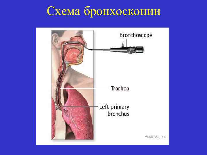 Схема бронхоскопии 