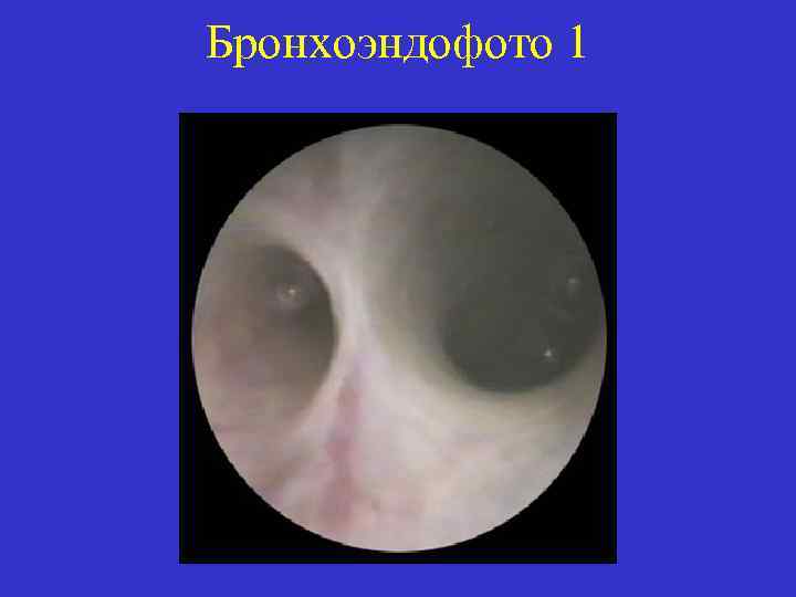 Бронхоэндофото 1 