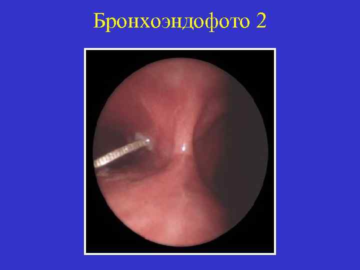 Бронхоэндофото 2 
