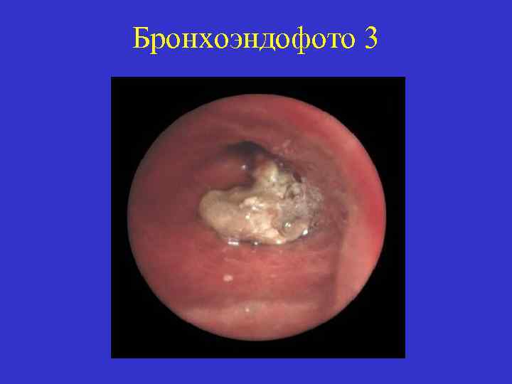 Бронхоэндофото 3 