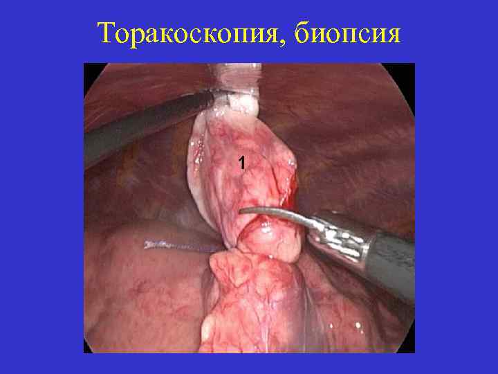 Торакоскопия, биопсия 