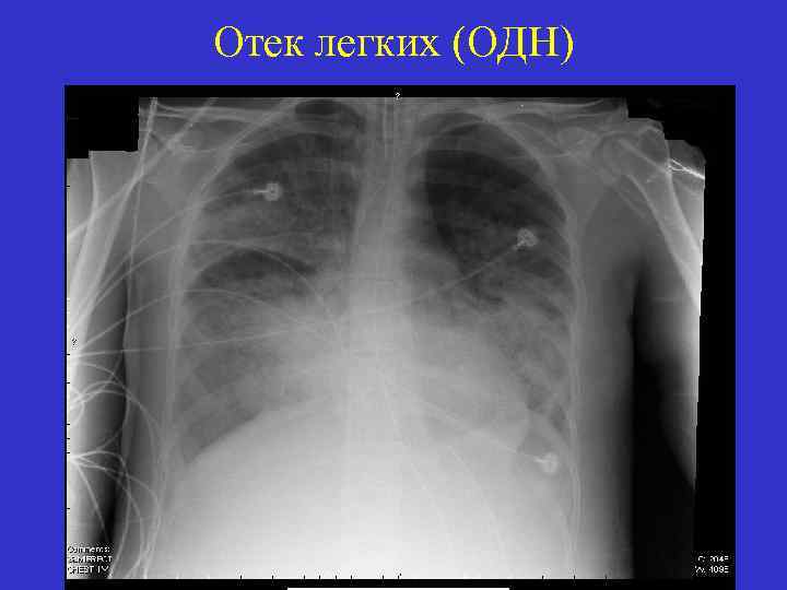 Отек легких (ОДН) 