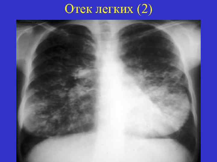 Отек легких (2) 