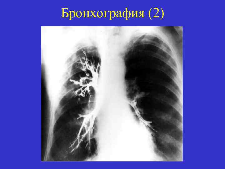 Бронхография (2) 
